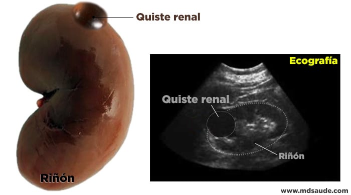 Aspecto de un quiste renal – En el riñón y en la ecografía