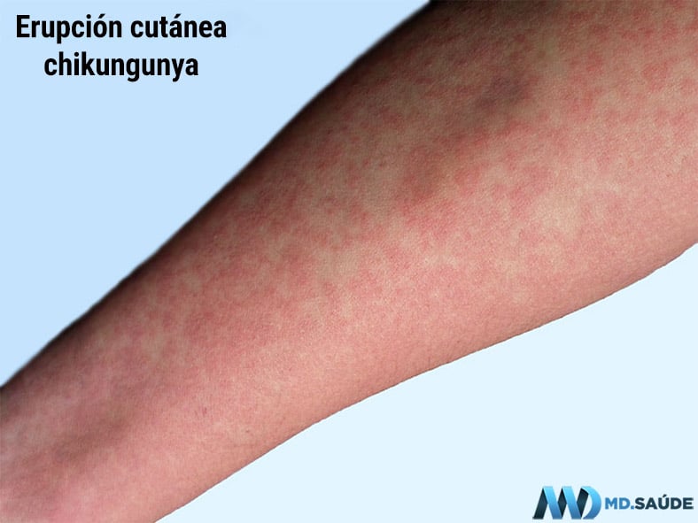 Erupción cutánea con manchas rojizas en un paciente con chikungunya.