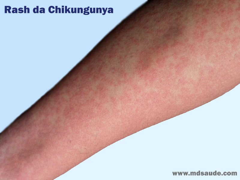 Chikungunya