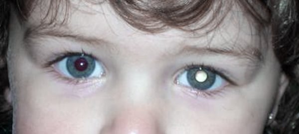 Retinoblastoma - Leucoria no olho esquerdo