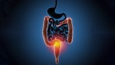 Colitis