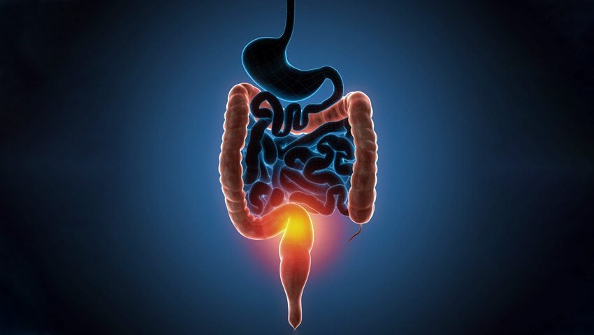 RETOCOLITE ULCERATIVA - Causas, sintomas e tratamento - MD.Saúde