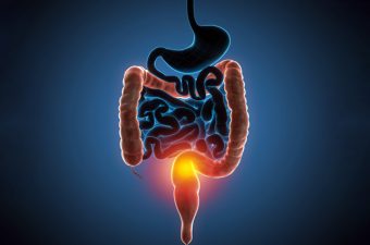 Retocolite ulcerativa