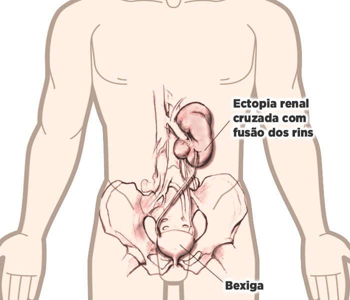 Ectopia renal cruzada com fusão dos rins