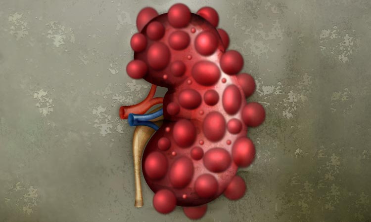 Poliquistosis renal
