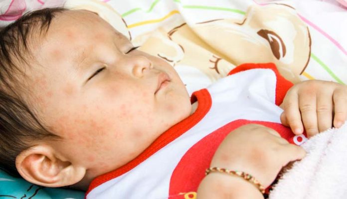 roseola-exantema Roséola infantil - exantema súbito