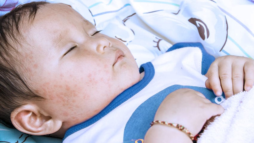 Roseola Exantema Subito Sintomas E Tratamento Md Saude