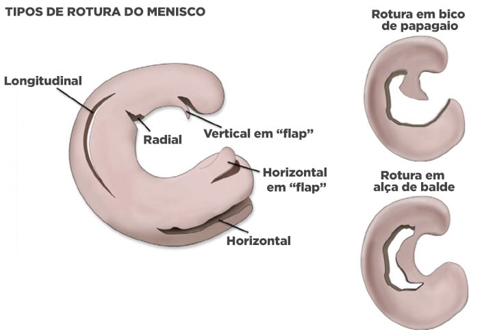 Rotura do menisco: horizontal, vertical, radial, em bico de papagaio ou em alça de balde