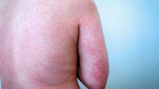 Roseola Exantema Subito Sintomas E Tratamento Md Saude