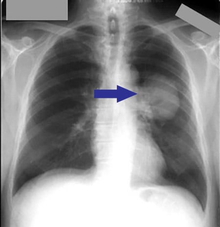 Radiografia de tórax com imagem sugestiva de tumor no pulmão esquerdo