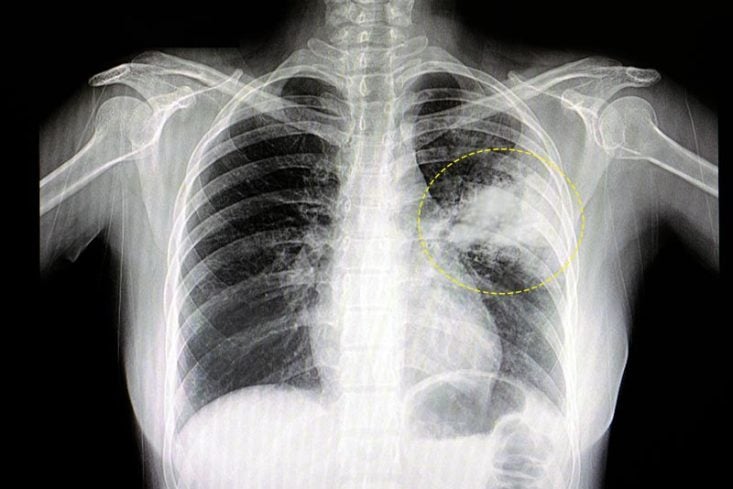 Radiografía de tórax: neumonía en pulmón izquierdo.