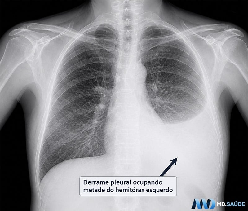 Radiografia de tórax mostrando grande derrame pleural à esquerda, ocupando aproximadamente metade do hemitórax.