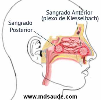 Epistaxis anterior y epistaxis posterior.