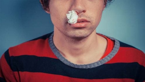 Sangrados de nariz (epistaxis): causas y tratamiento