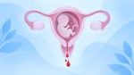 Sangramento vaginal na gravidez