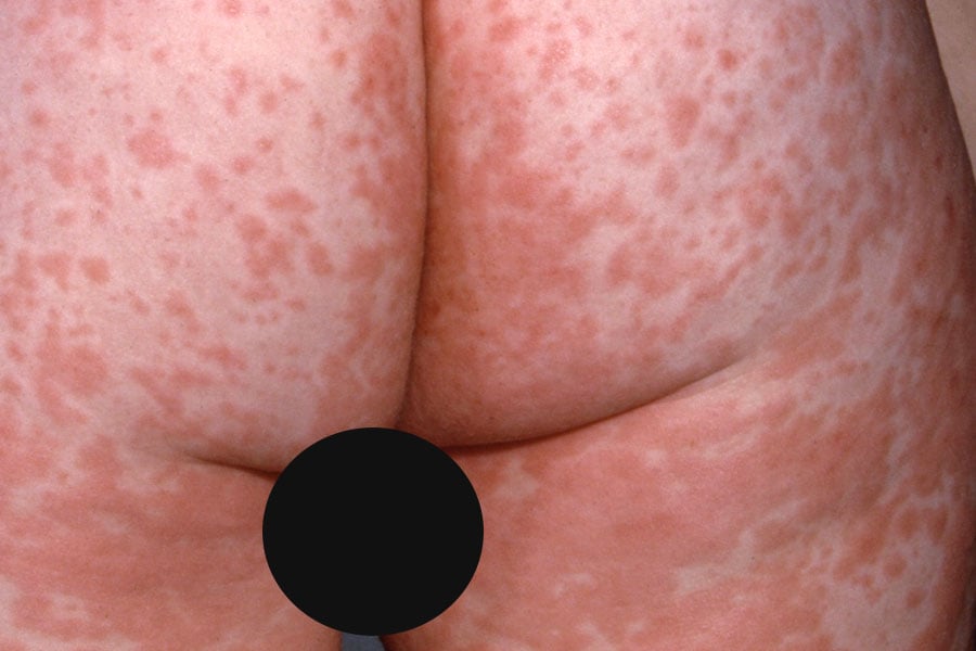 Rash do Sarampo