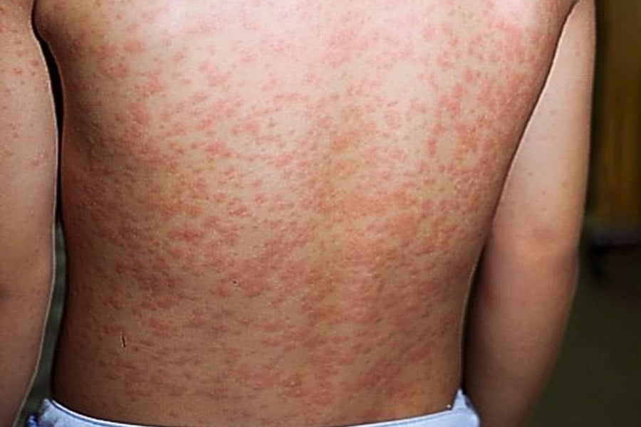 Rash do Sarampo