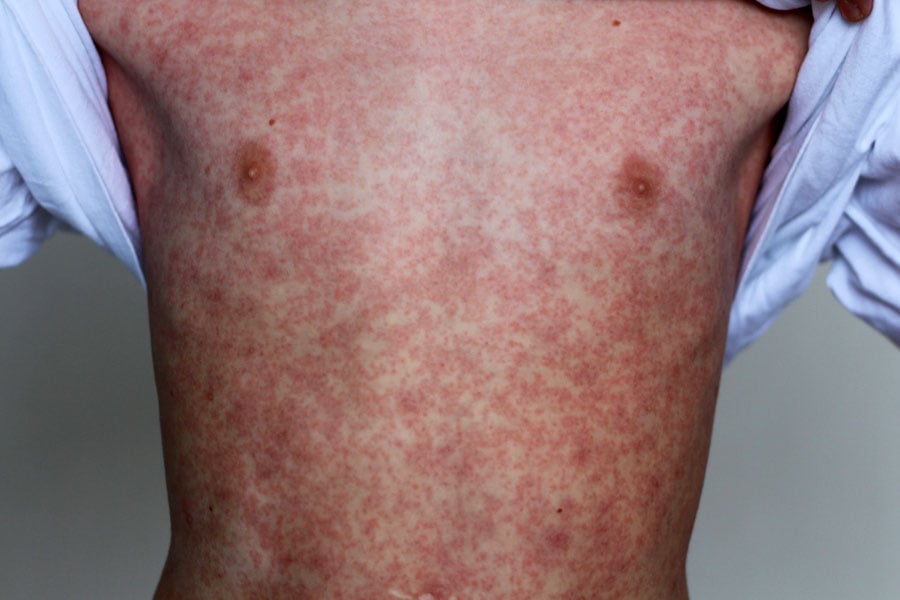 Rash do Sarampo