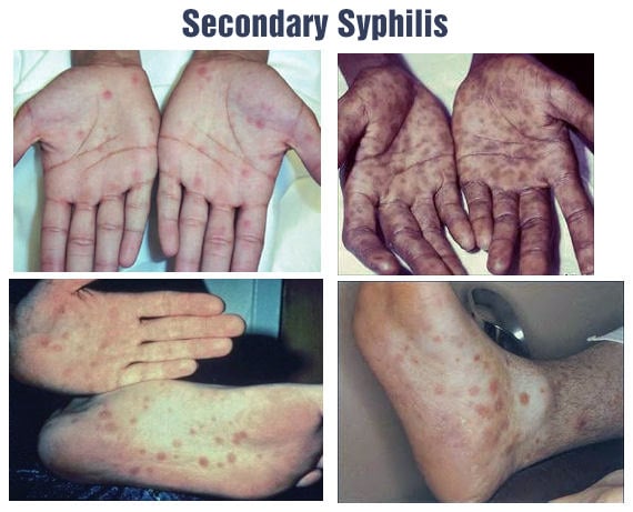 Syphilis Symptoms Tests Transmission Treatment And Cure