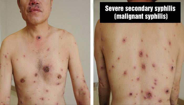 Severe secondary syphilis (malignant syphilis) with lesions all over the body