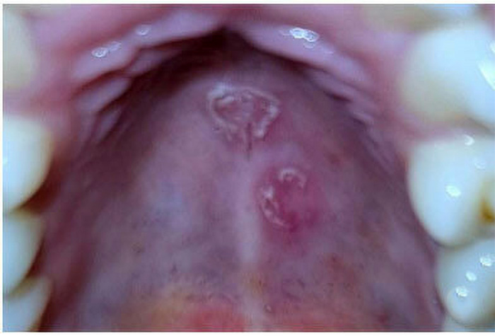 Sífilis secundaria - lesiones en el paladar duro (techo de la boca)