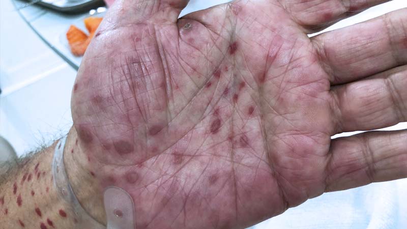 Sífilis secundaria: erupciones en la palma de la mano