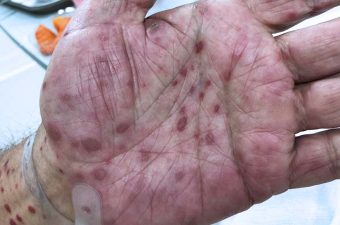 FOTOS DE SÍFILIS – Fases Precoce e Avançada