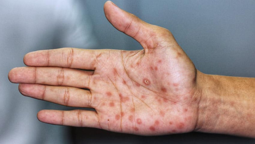 Sífilis secundaria: erupciones en la palma de la mano