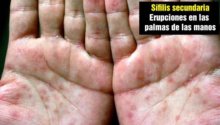 Sífilis secundaria en las manos