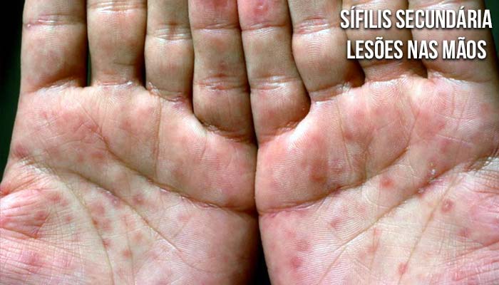 Sífilis secundária - erupções nas mãos