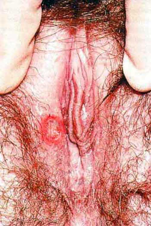 Chancro en la vulva - sífilis primaria