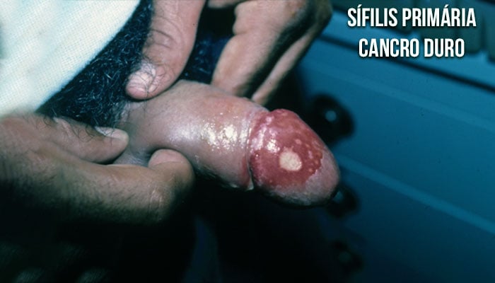 Úlcera da sífilis - cancro duro