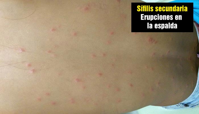 Sífilis secundaria: erupciones en la espalda