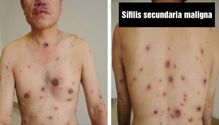 Sífilis secundaria grave (sífilis maligna) con lesiones por todo el cuerpo