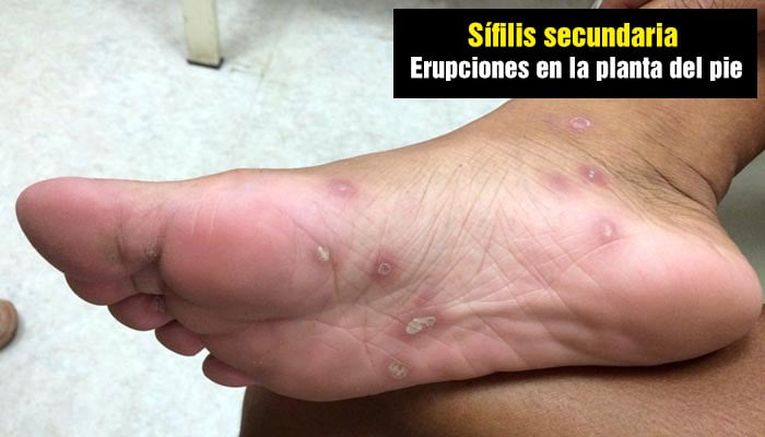 Sífilis secundaria: erupciones en la planta del pie.