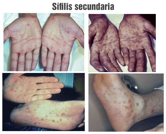 Sífilis secundaria: erupciones en las palmas de las manos y las plantas de los pies