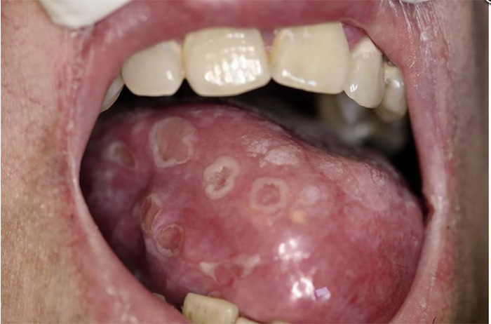 Sífilis secundaria en la lengua