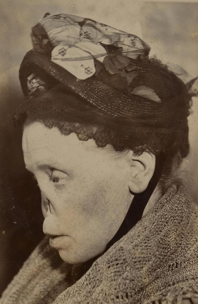 Destruction of nasal cartilage due to tertiary syphilis