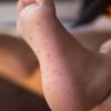 HAND-FOOT-AND-MOUTH DISEASE – Symptoms and Treatment