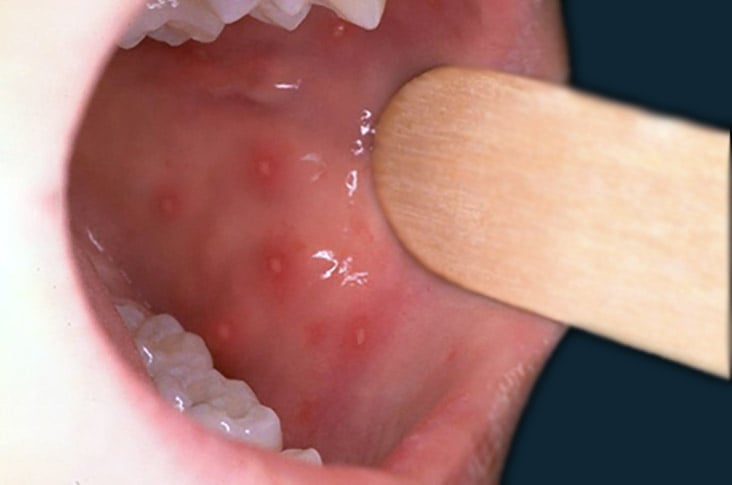 Herpangina: o que é, sintomas e tratamento - Tua Saúde