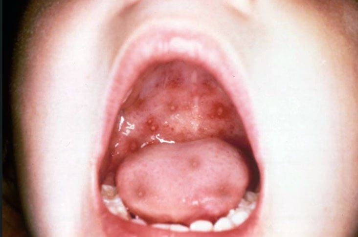 Lesões no palato e língua na DMPB