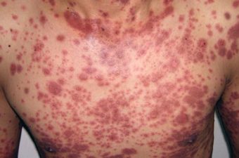 SÍNDROME DE STEVENS-JOHNSON – Necrólise Epidérmica Tóxica