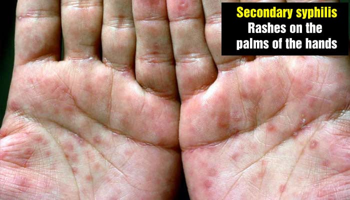 Secondary syphilis - rashes on the palms