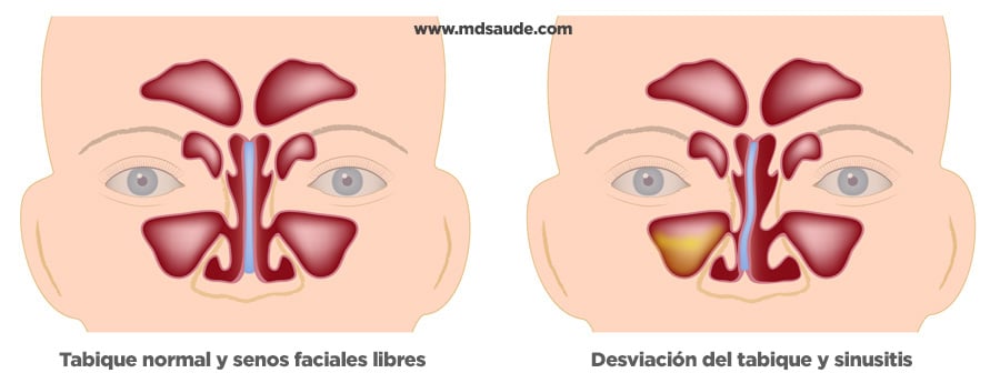 Sinusitis del seno maxilar causada por desviación del tabique 