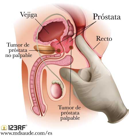 El tacto rectal puede identificar o no un tumor de próstata