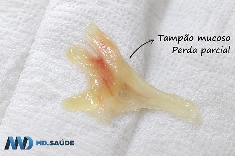Perda parcial do tampão mucoso, com pequena quantidade de muco translúcido e discretas estrias de sangue sobre papel higiênico branco.