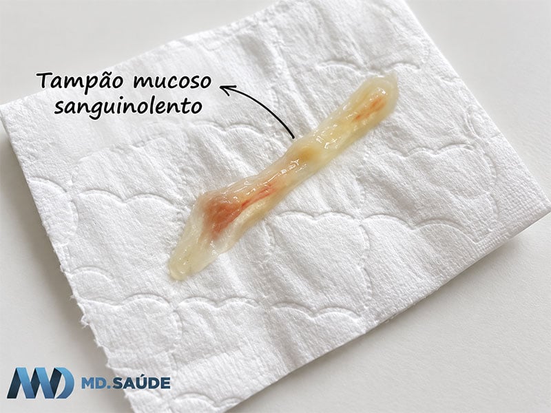 Tampão mucoso de aspecto gelatinoso, amarelado e com pequenas estrias de sangue sobre papel higiênico.