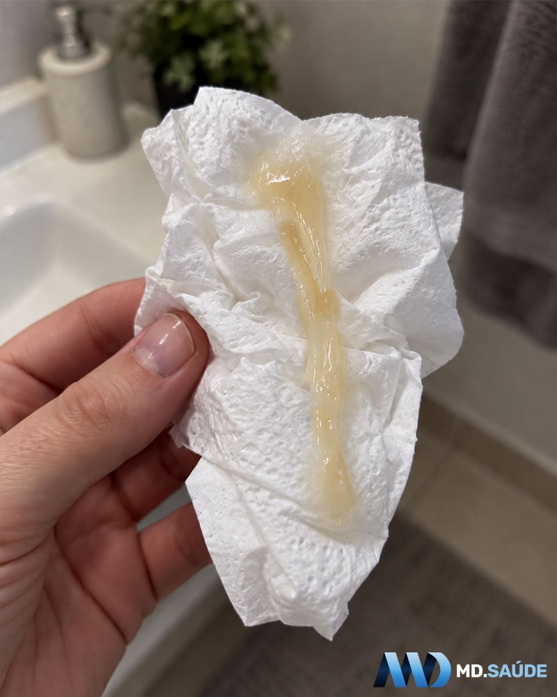Mão segurando papel higiênico com muco espesso, alongado e amarelado, de aspecto semelhante a catarro.