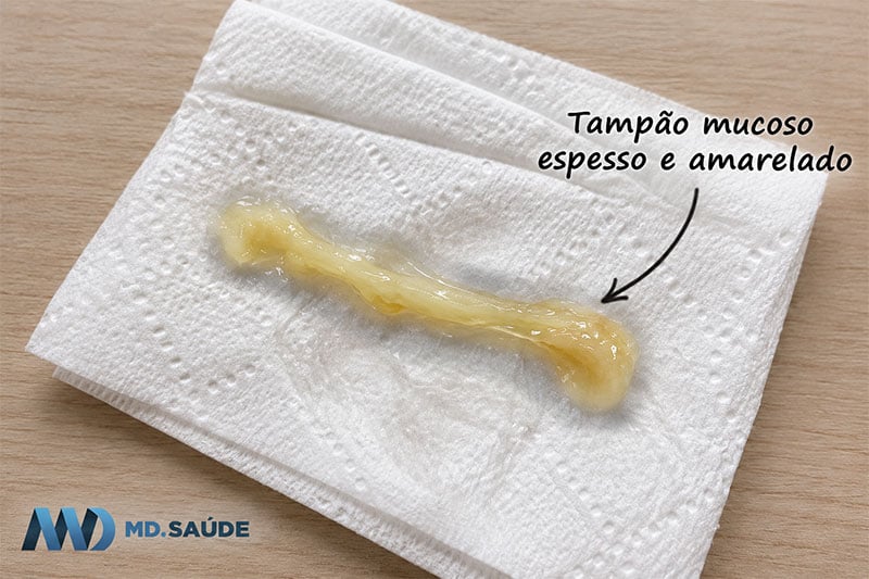 Tampão mucoso espesso e amarelado sobre papel higiênico branco, com aspecto gelatinoso e alongado.