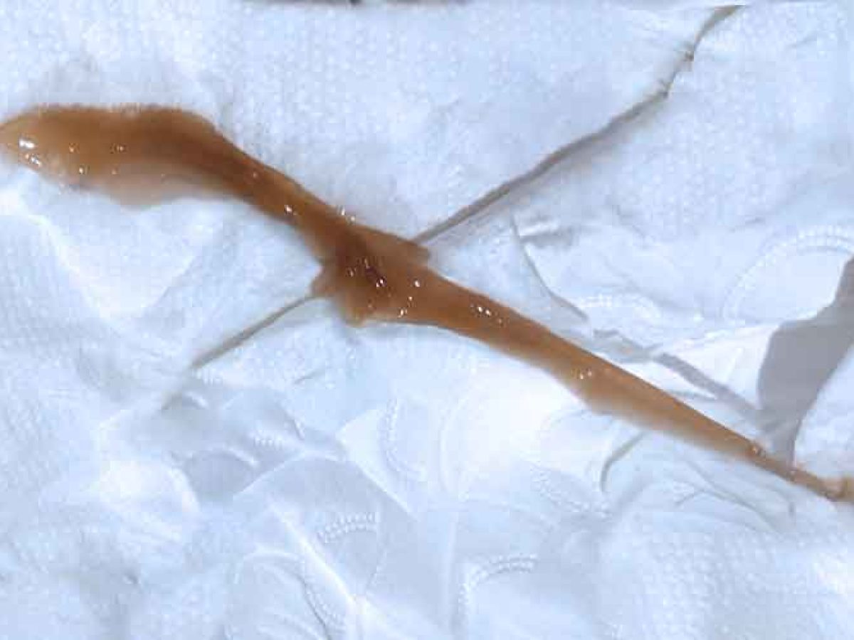 Tampão mucoso | O que é, como é, sintomas e fotos